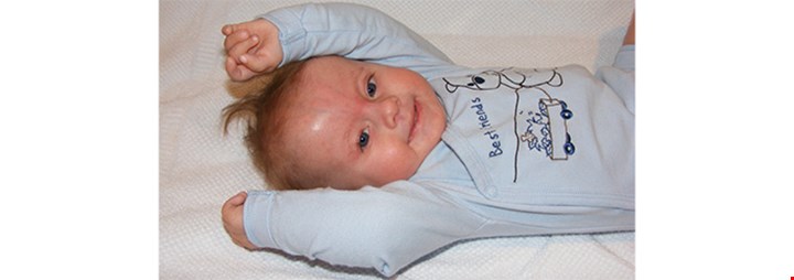 Bilde av gutt med trisomi 18